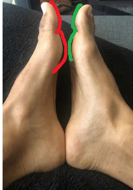 hyper extended big toe